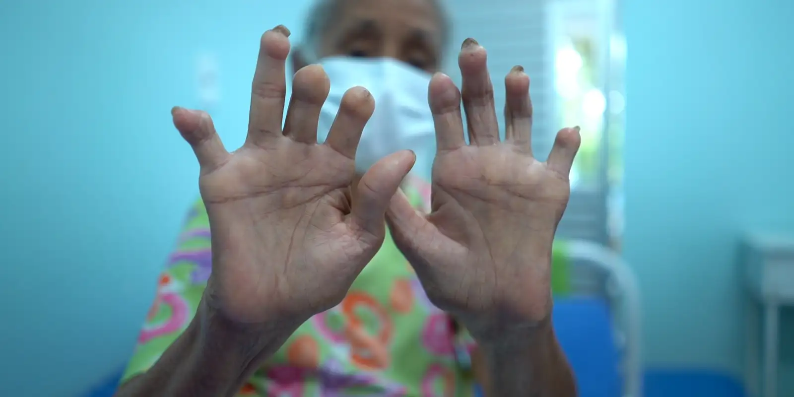 Menos atenção e recursos: doenças negligenciadas seguem como desafio