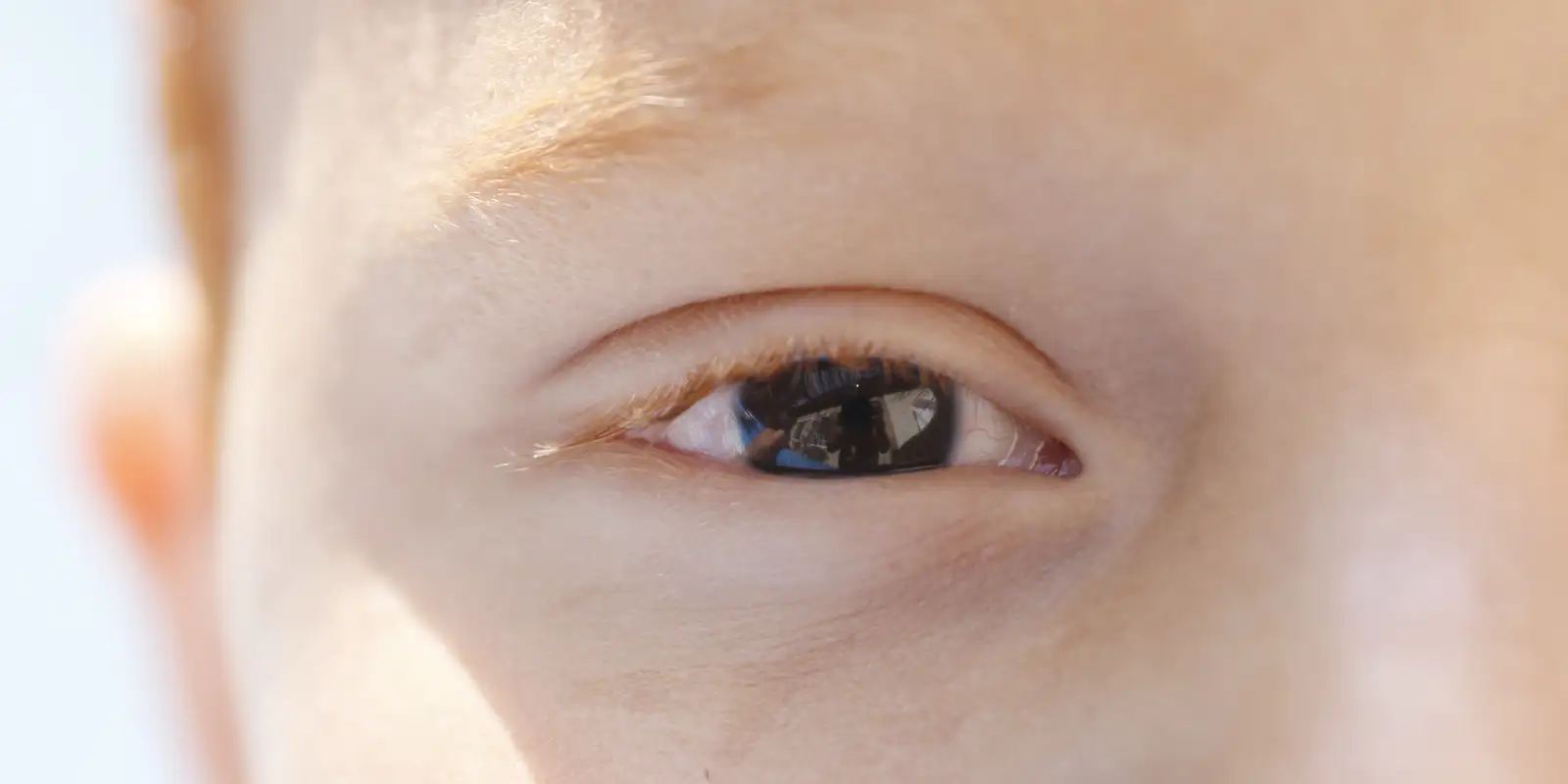 Fotoceratite exige cuidados redobrados no verão