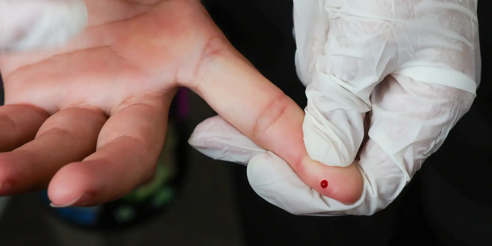 Ministério incorpora teste rápido para diagnóstico de dengue ao SUS