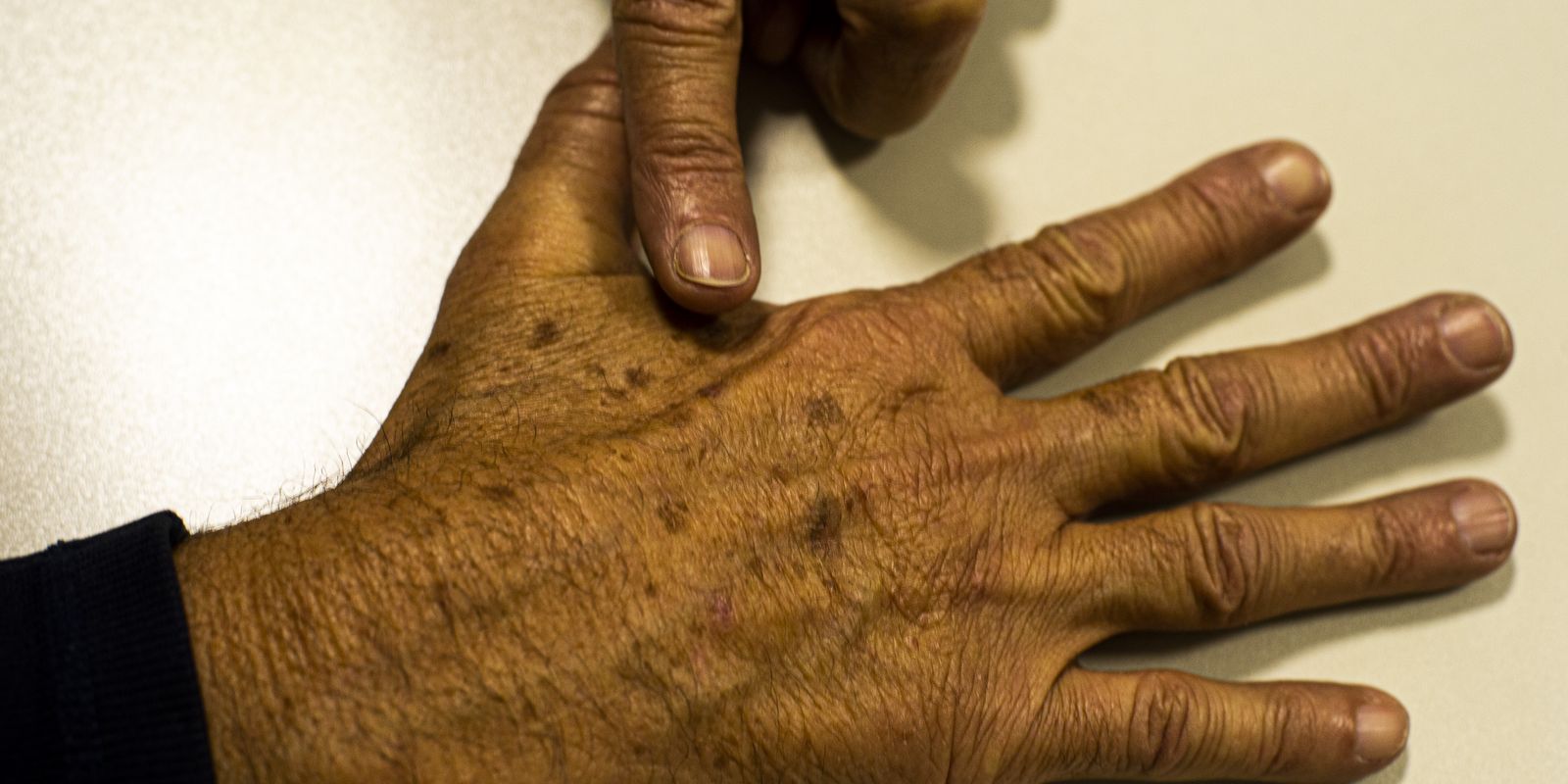 Câncer de pele: falta de dados sobre pacientes dificulta prevenção