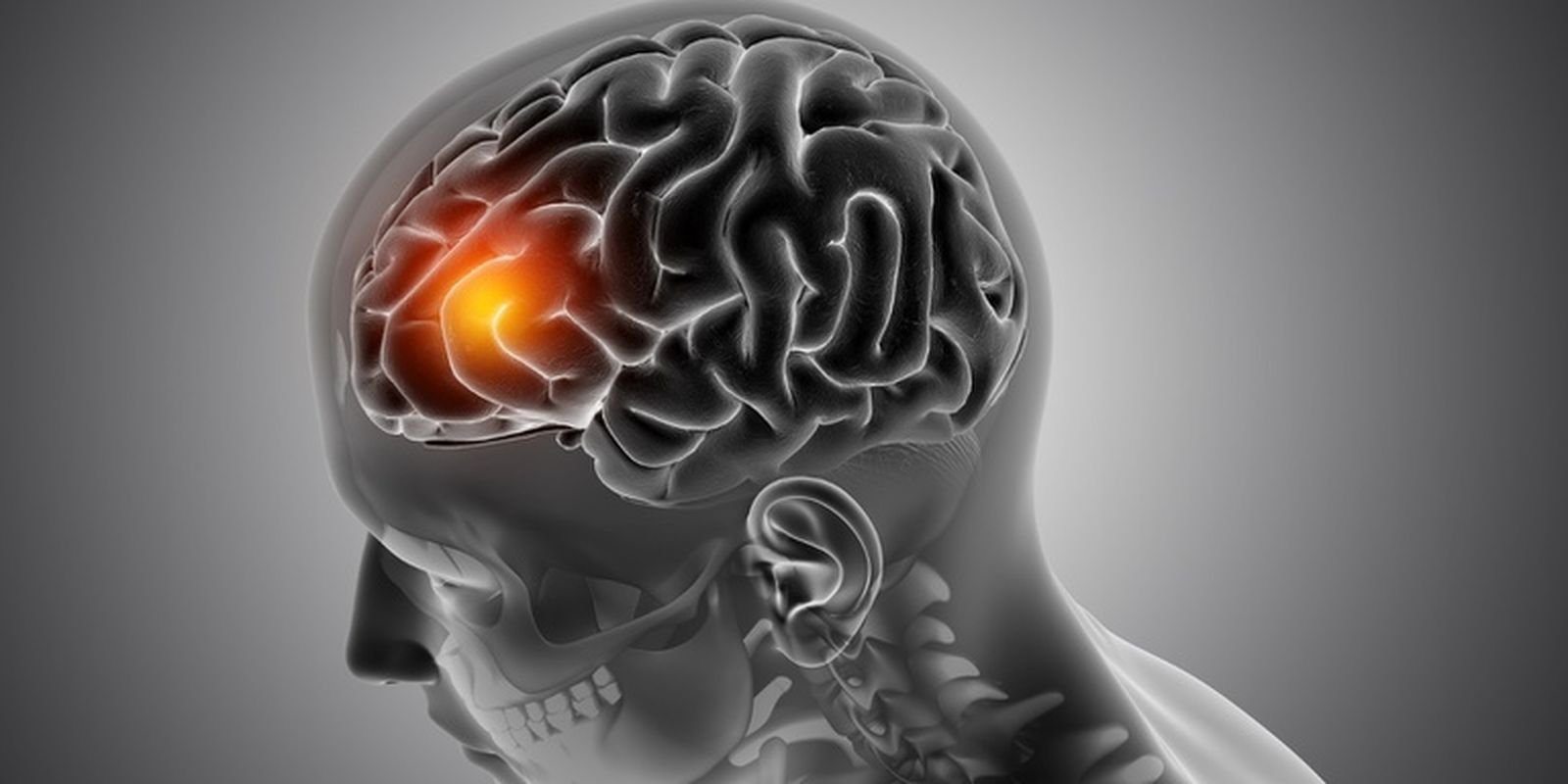 AVC: neurologista explica como identificar os primeiros sinais